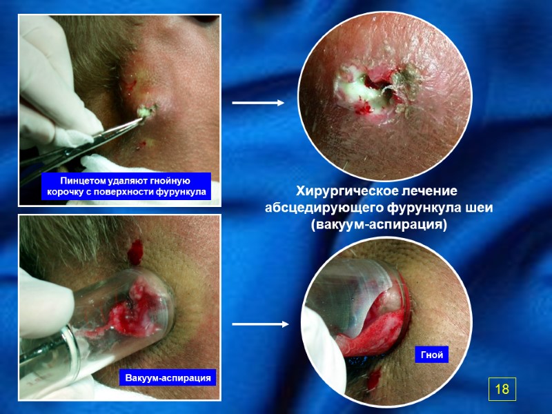 Хирургическое лечение  абсцедирующего фурункула шеи (вакуум-аспирация) Пинцетом удаляют гнойную  корочку с поверхности